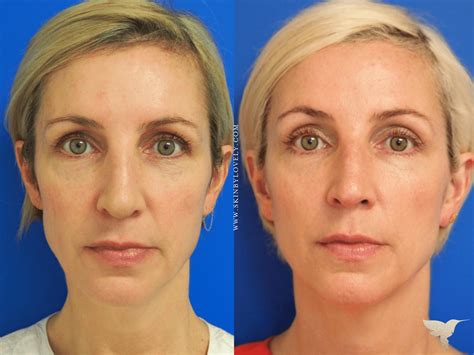 Sculptra: Before & After Results & How it Works (+ Video).